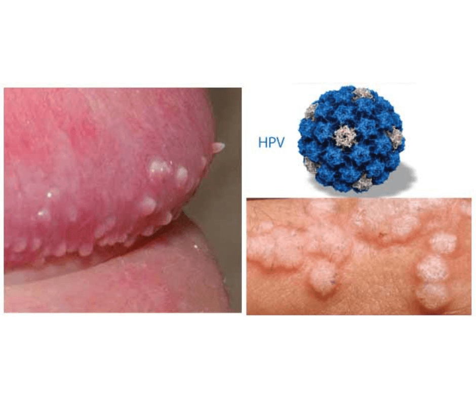 Virus HPV ở nam là gì tuiriviu
