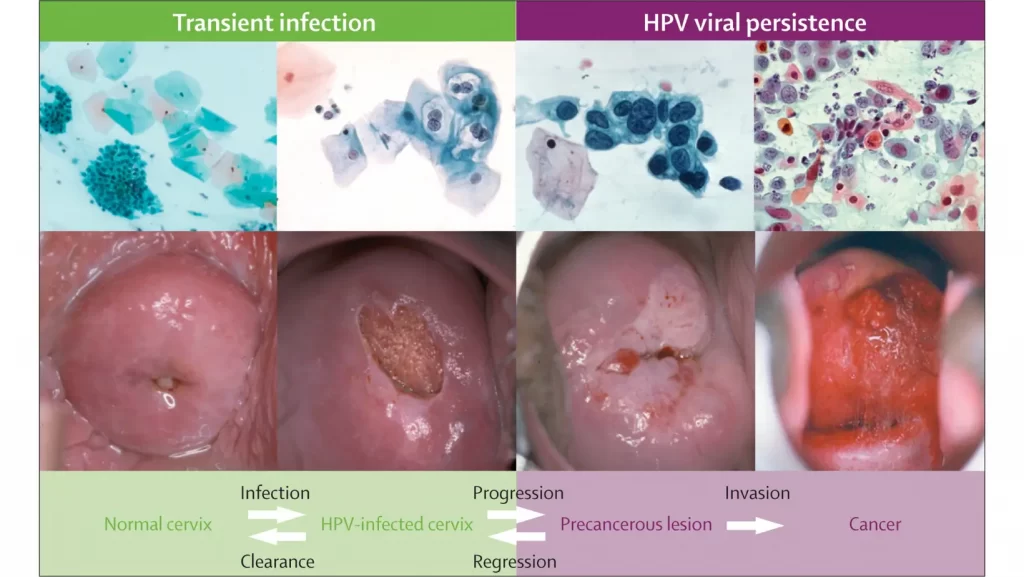 Dấu hiệu nhiễm bệnh HPV tuiriviu